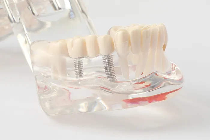 インプラント治療から歯の移植も